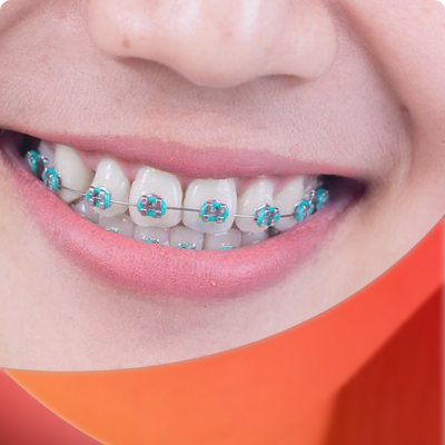 Braces in Dubai 